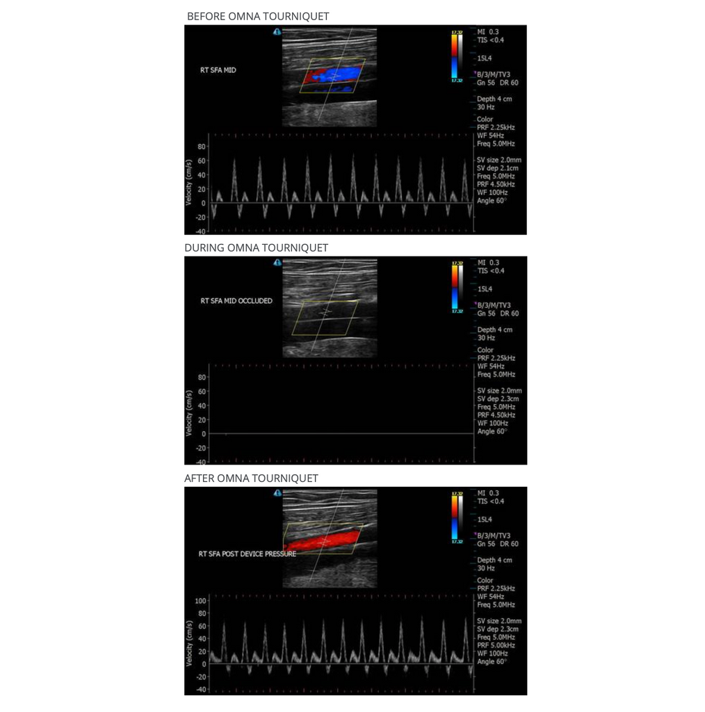 OMNA Tourniquet: Before - During - After Application 