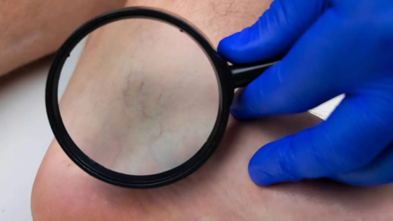 Varices au niveau de la cheville vue à la loupe