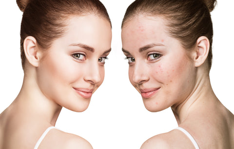 Young woman with and without acne