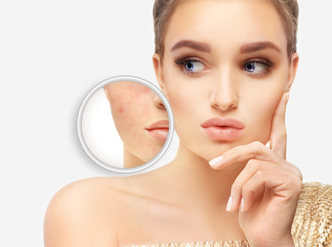 Young woman with and without acne - Soap.Club