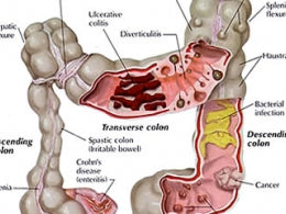 Diagram of the colon diseases