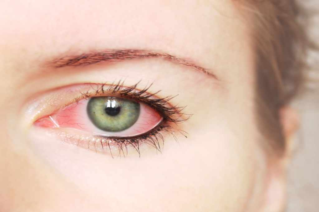 irritation in eyes