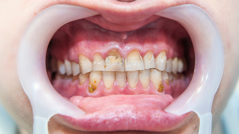 what does fluorosis look like
