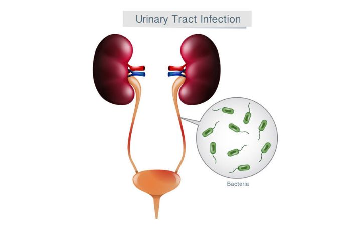 Causes of UTI