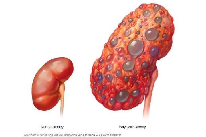 Common symptoms of kidney