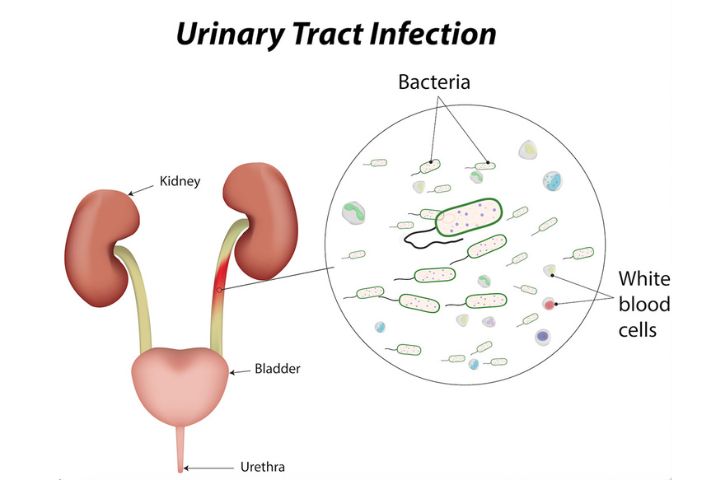 Common UTI symptoms during Pregnancy