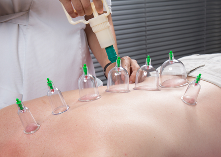 practitioner using vacuum cupping