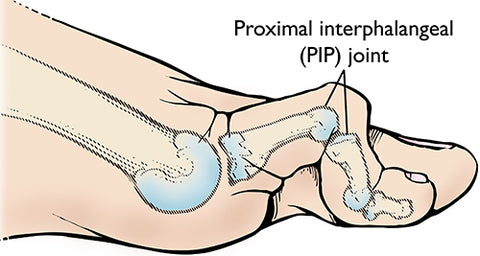 What does a hammer toe look like?