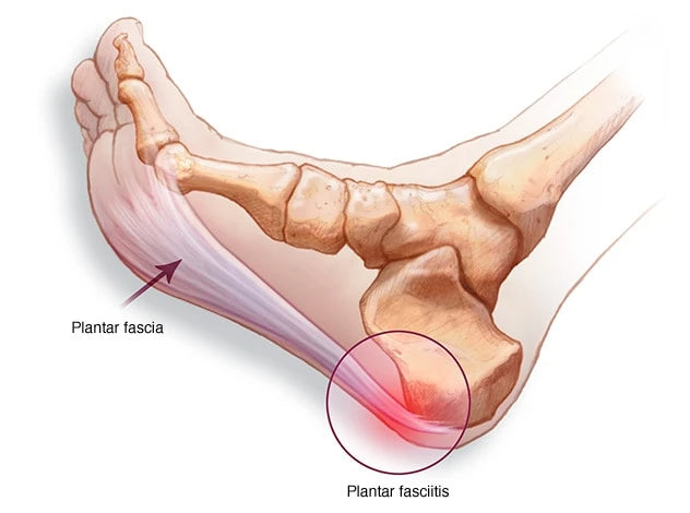 Plantar Fasciitis. What is it? How do you care for it? – My-Happy