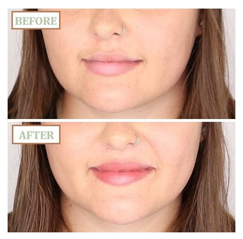 hanalei lip treatment before and after