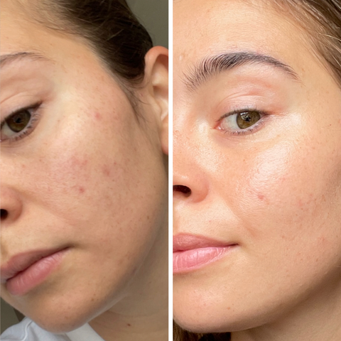 post-pill acne before and after