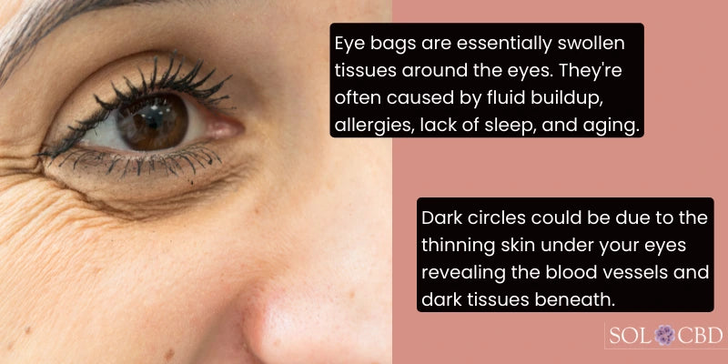 Understanding  Eye Bags and Dark Circles