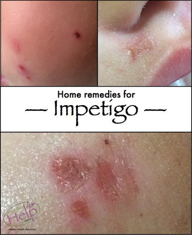 Home Remedies for Impetigo