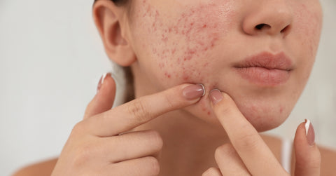 Woman with Acne