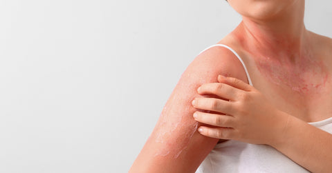 Woman with Red Sunburned Skin