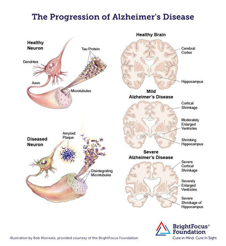 Moderate Alzheimer's Disease - Middle Stage