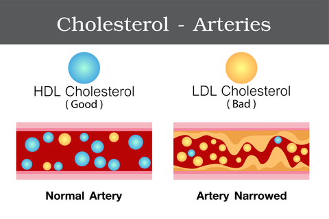 Atherosclerosis Blocked Arteries