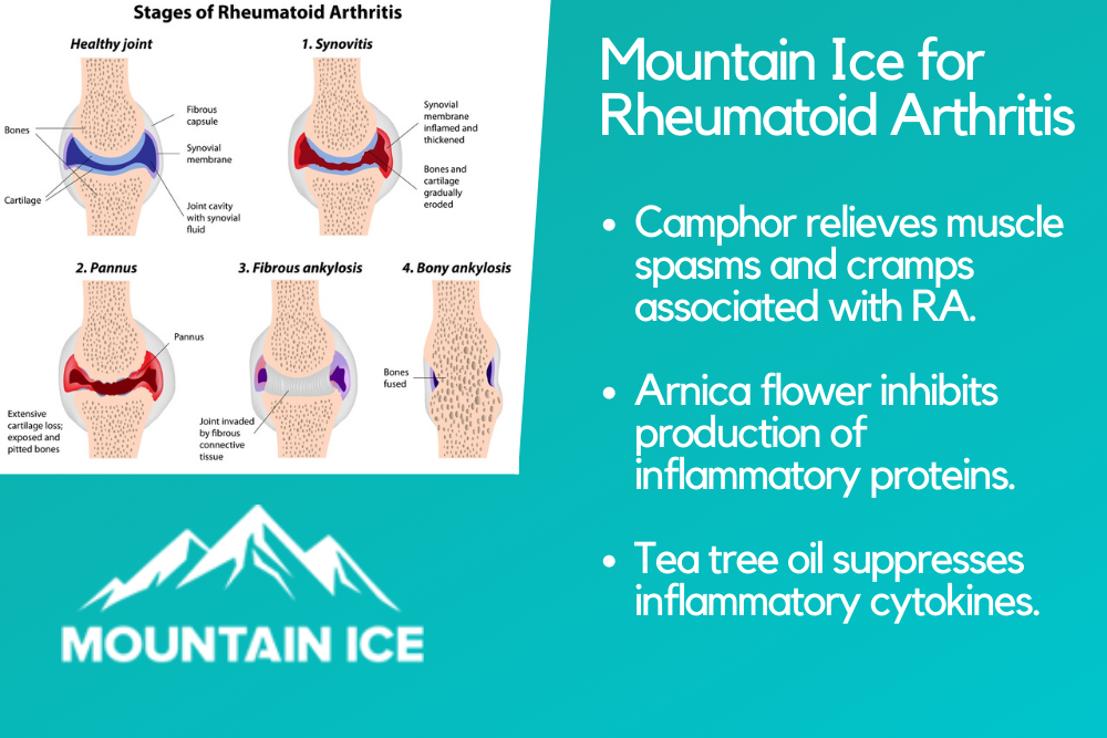 Mountain Ice for Rheumatoid Arthritis
