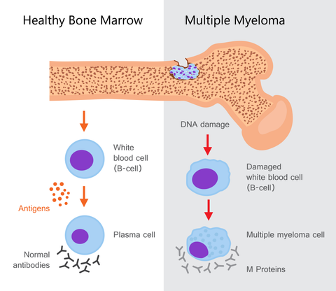 Multiple Myeloma Chart