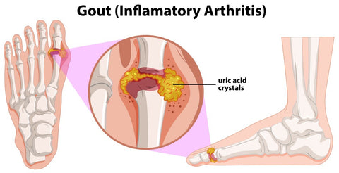 Gout Foot Chart