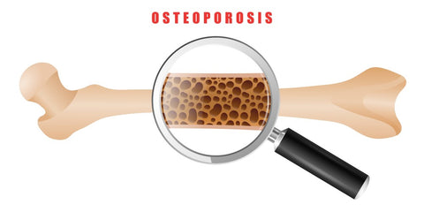 Osteoporosis Title Card