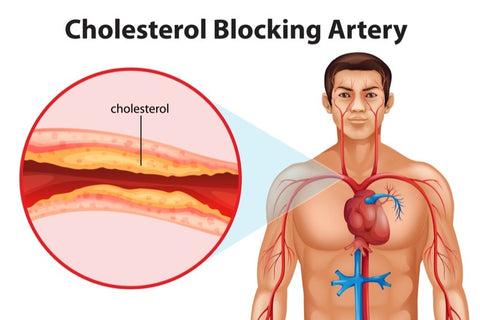 Cholesterol Blocking Artery