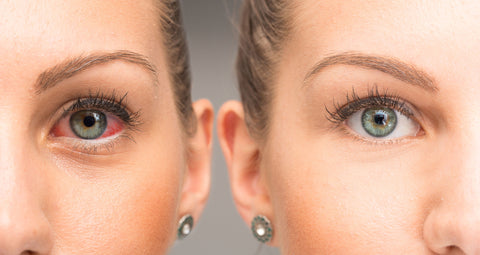 Eye Allergies Treatment