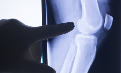 Arthritis Management