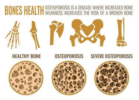 Osteoporosis Bone Comparison