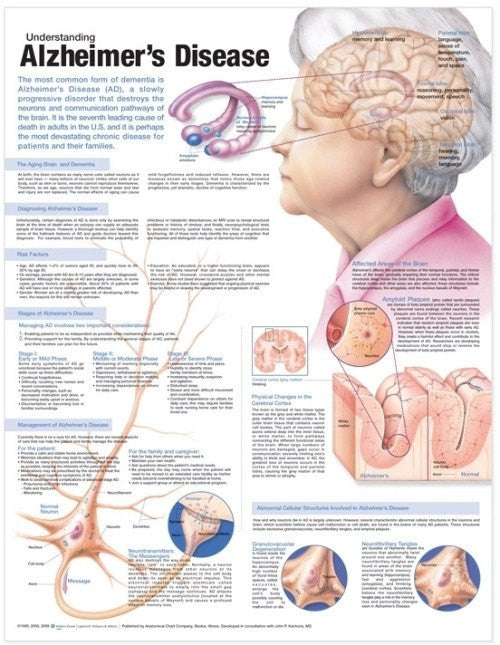 Understanding Alzheimer's Disease Informational Poster