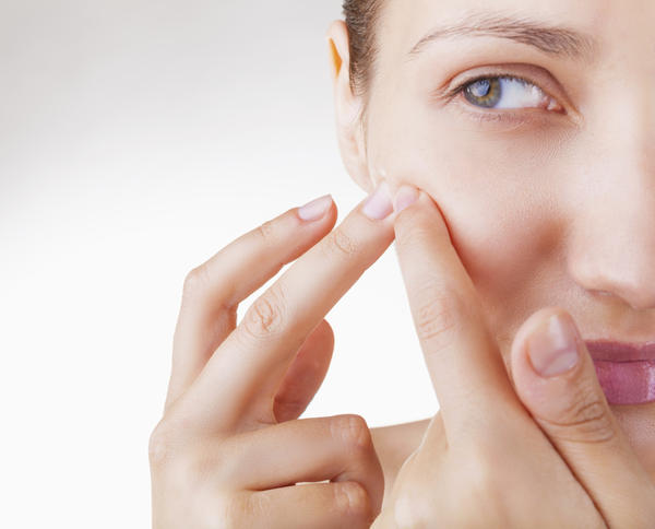 Treating Pimples Naturally
