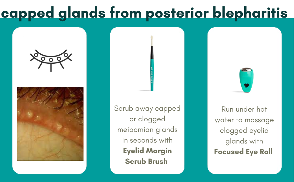 Find your eyelid margin debris - from posterior blepharitis meibomian gland dysfunction