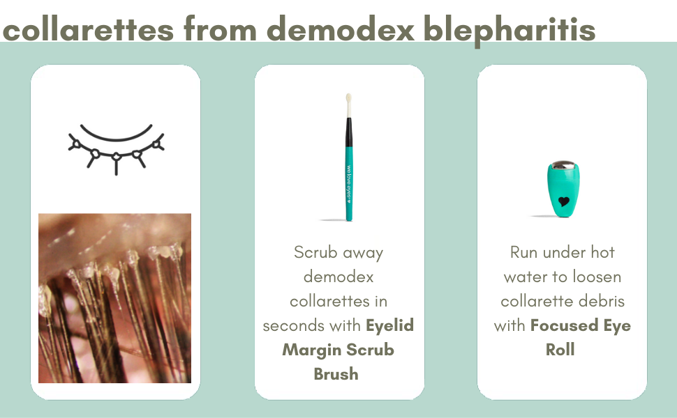 Find your eyelid margin debris - from posterior blepharitis demodex mites