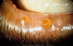 Capped Meibomian Glands can lead to a stye