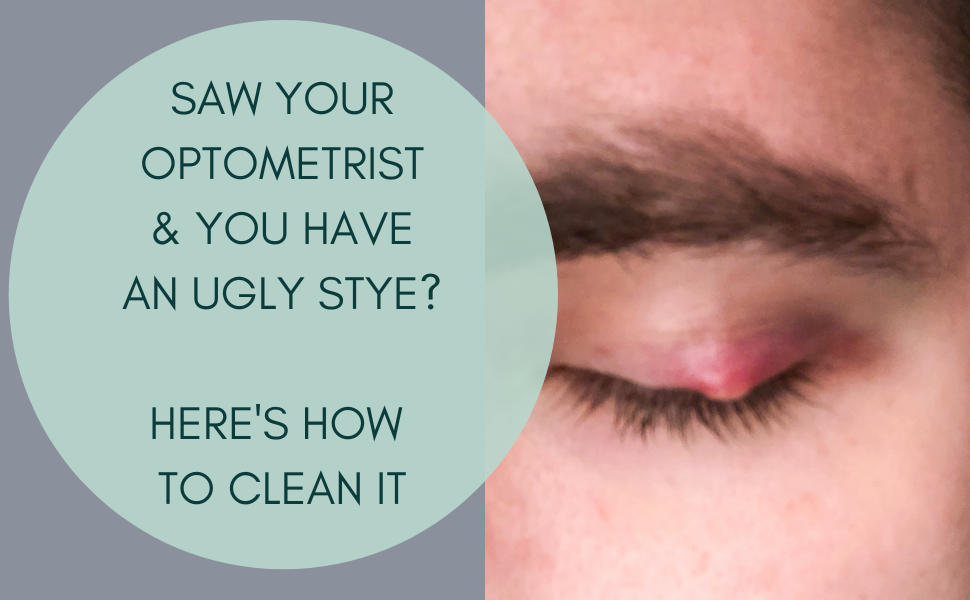 How Do I Clean a Stye; This is what a stye can look like. Read this before you cancel that zoom meeting