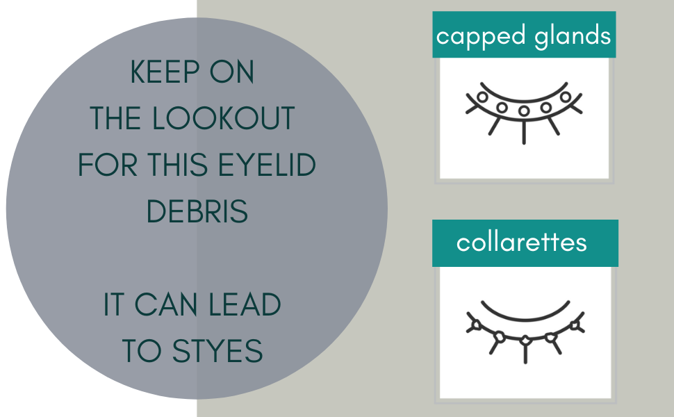 How Do I Clean a Stye: Look for and remove eyelid margin debris that can lead to future styes