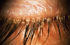 Demodex blepharitis can lead to styes