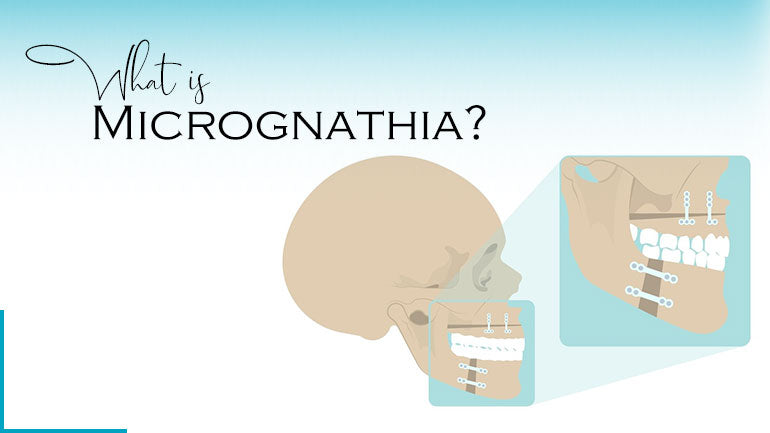 What Is Micrognathia?