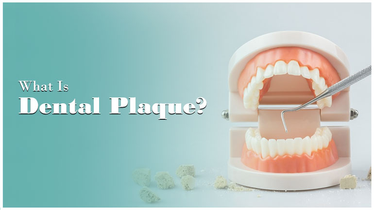 What Is Dental Plaque?