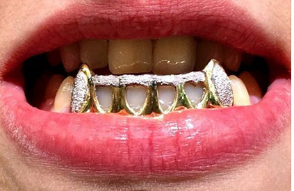 Custom Made 14k Gold Overlay Removable Grillz Teeth /Gold Plate Caps ...