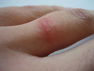 wedding ring rash