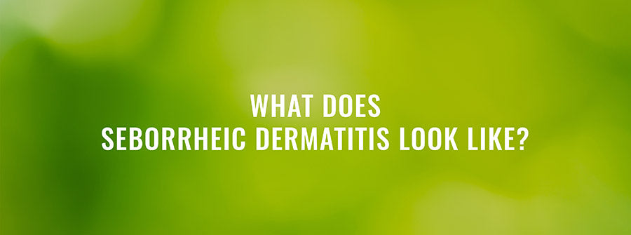 What Does Seborrheic Dermatitis Look Like?