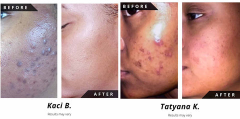 Noir D'or® Customer's Before & After Acne and Blemishes Results Images