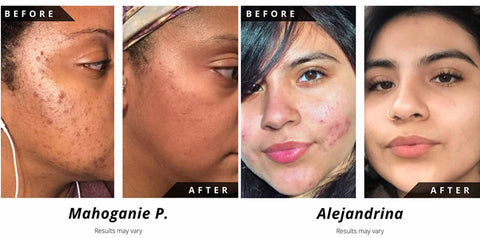 Noir D'or® Customer's Before and After Acne and Blemishes Results Images