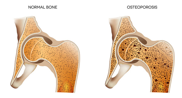 Osteopenia