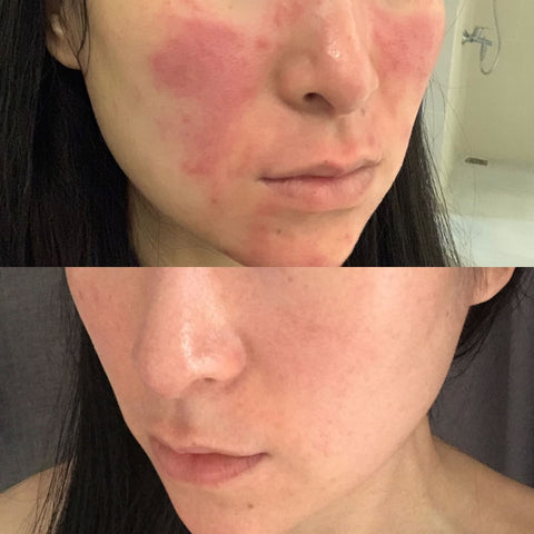 skin before and after Rosacea skin 