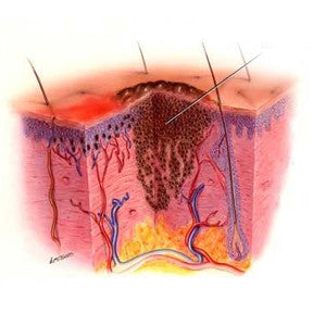 complete erosion of the pigment producing cells