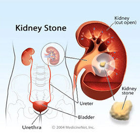 Kidney stones are one of the most common kidney diseases in India