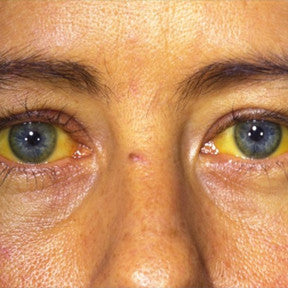 Jaundice (yellow discoloration of the skin)