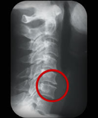 cervical x-ray bone spurs stomach sleeping pure posture